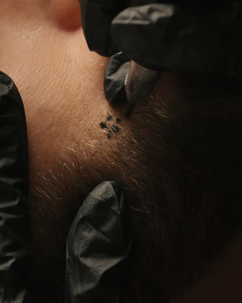 Micropigmentation capillaire, camouflage de cicatrice à la barbe, institut Maison GOĒN